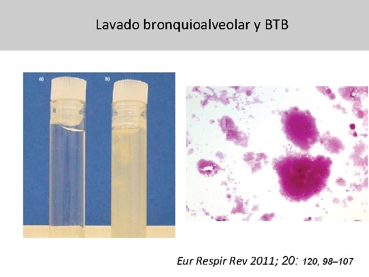 Lavado bronquioalveolar y BTB 31/07/13 Eur Respir Rev 2011; 20: 120, 98– 107 