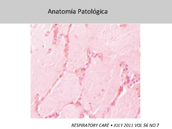 Anatomía Patológica 31/07/13 RESPIRATORY CARE • JULY 2011 VOL 56 NO 7 