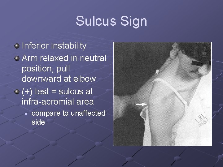 Sulcus Sign Inferior instability Arm relaxed in neutral position, pull downward at elbow (+)