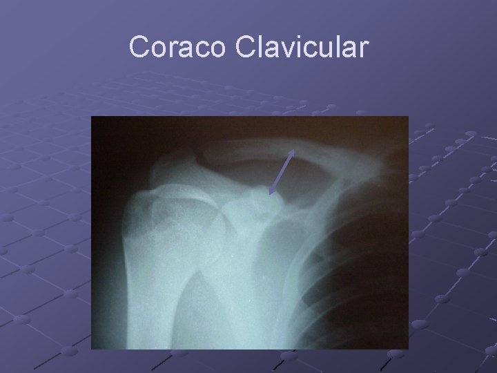 Coraco Clavicular 
