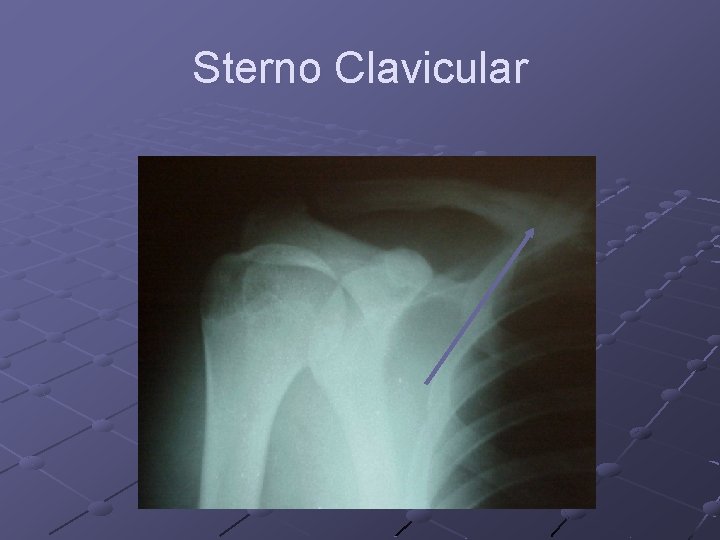 Sterno Clavicular 