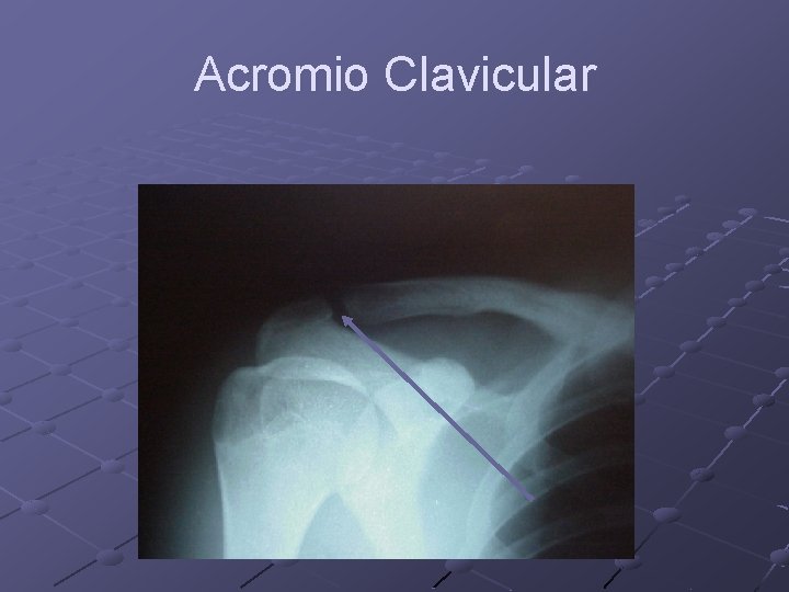 Acromio Clavicular 
