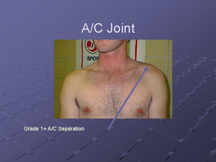 A/C Joint Grade 1+ A/C Separation 