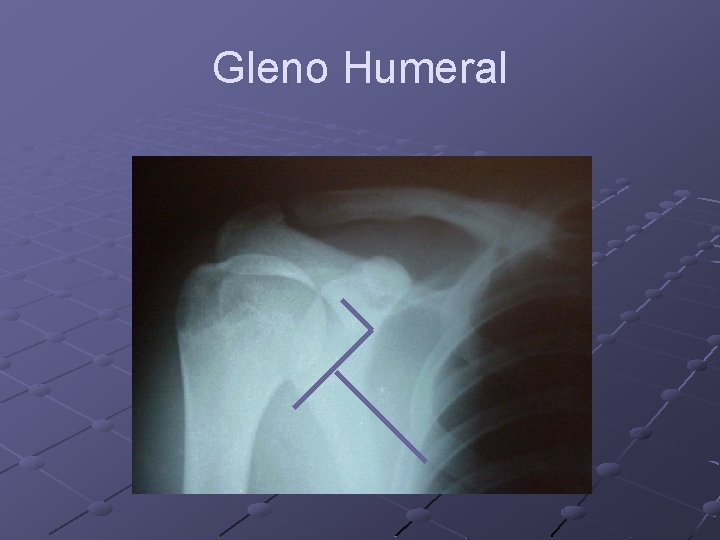 Gleno Humeral 