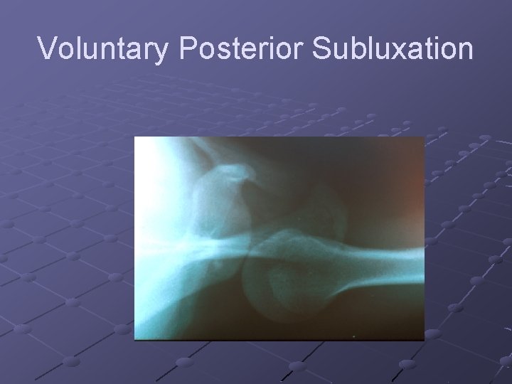 Voluntary Posterior Subluxation 