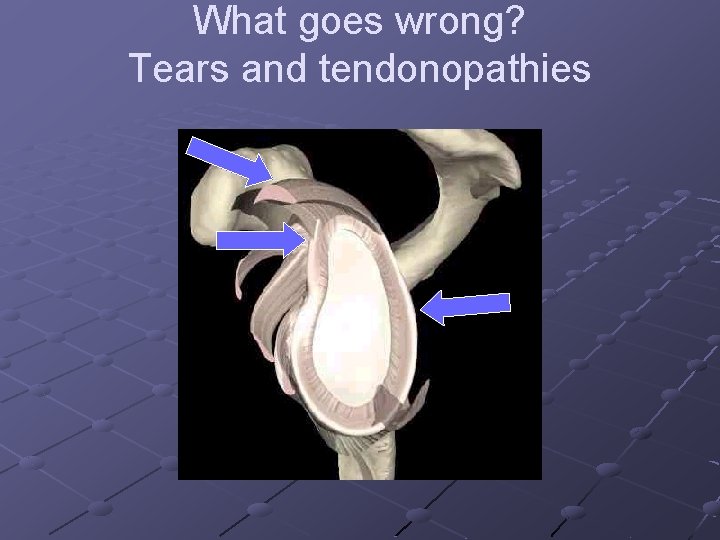 What goes wrong? Tears and tendonopathies 