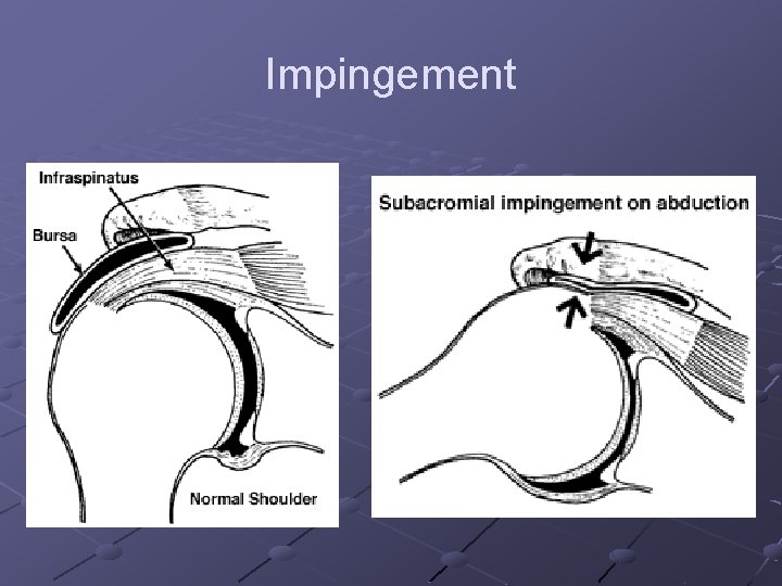 Impingement 