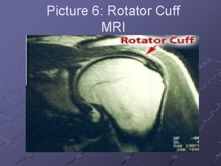 Picture 6: Rotator Cuff MRI 
