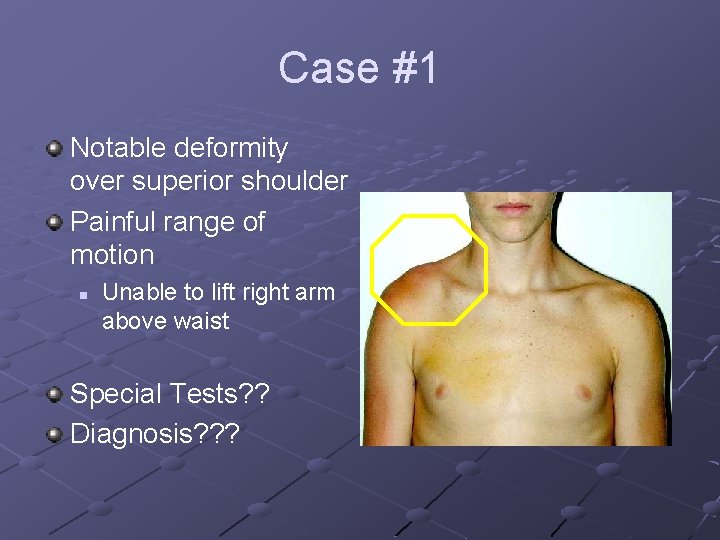 Case #1 Notable deformity over superior shoulder Painful range of motion n Unable to