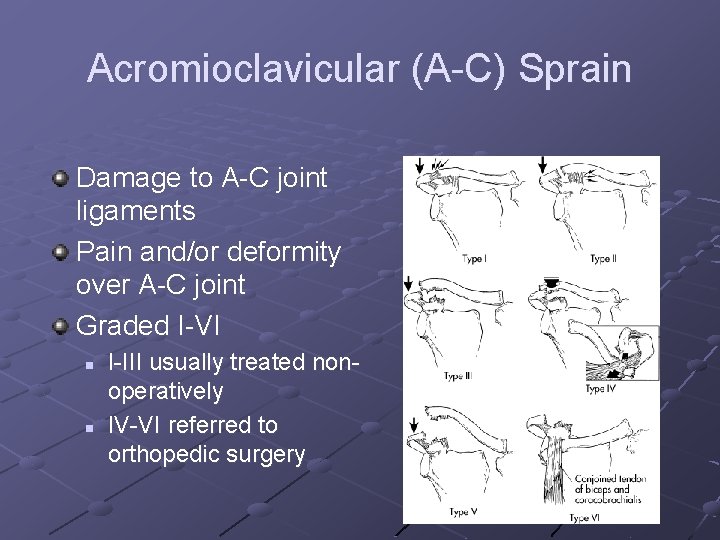Acromioclavicular (A-C) Sprain Damage to A-C joint ligaments Pain and/or deformity over A-C joint
