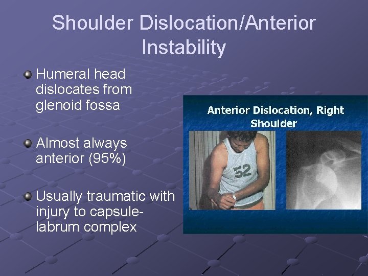 Shoulder Dislocation/Anterior Instability Humeral head dislocates from glenoid fossa Almost always anterior (95%) Usually