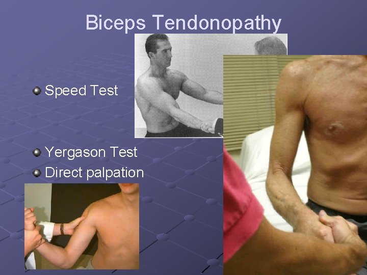 Biceps Tendonopathy Speed Test Yergason Test Direct palpation 