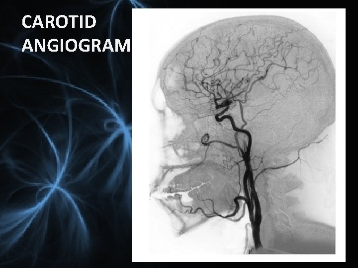 CAROTID ANGIOGRAM 