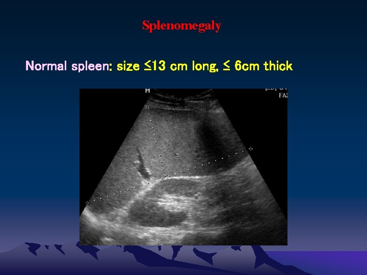 Splenomegaly Normal spleen: size ≤ 13 cm long, ≤ 6 cm thick 