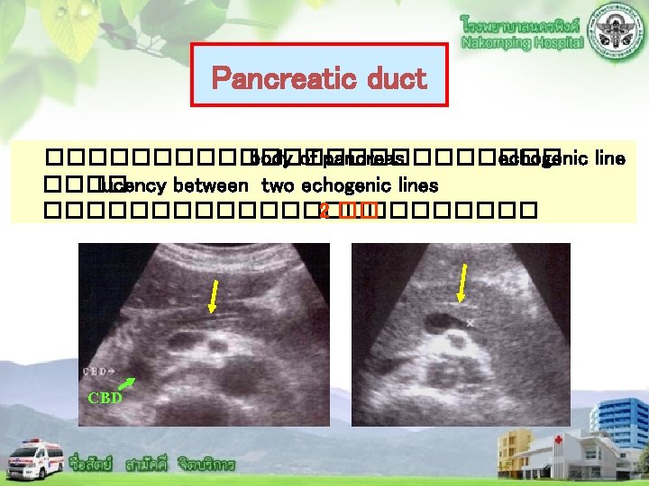 Pancreatic duct ��������� body of pancreas ������� echogenic line ���� lucency between two echogenic