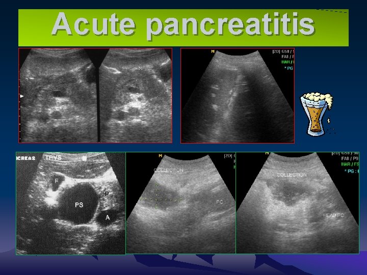 Acute pancreatitis 