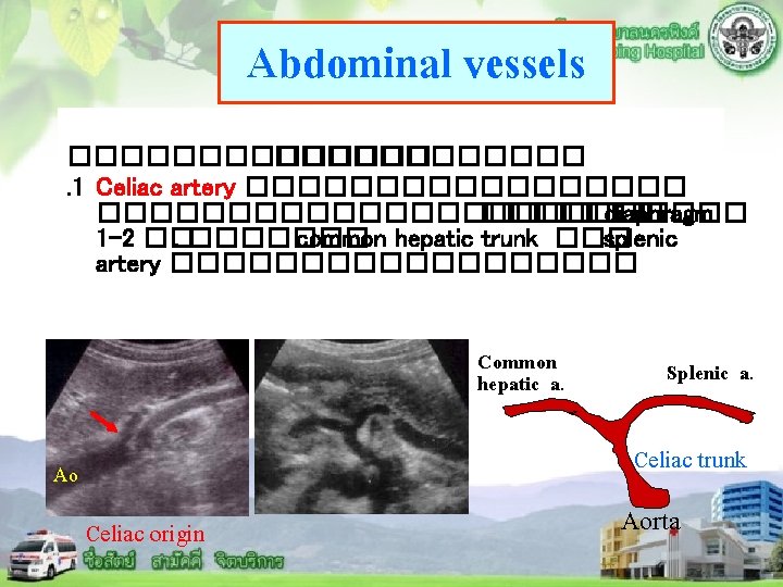 Abdominal vessels �������. 1 Celiac artery ��������������������� diaphragm 1 -2 ��. ������� common hepatic