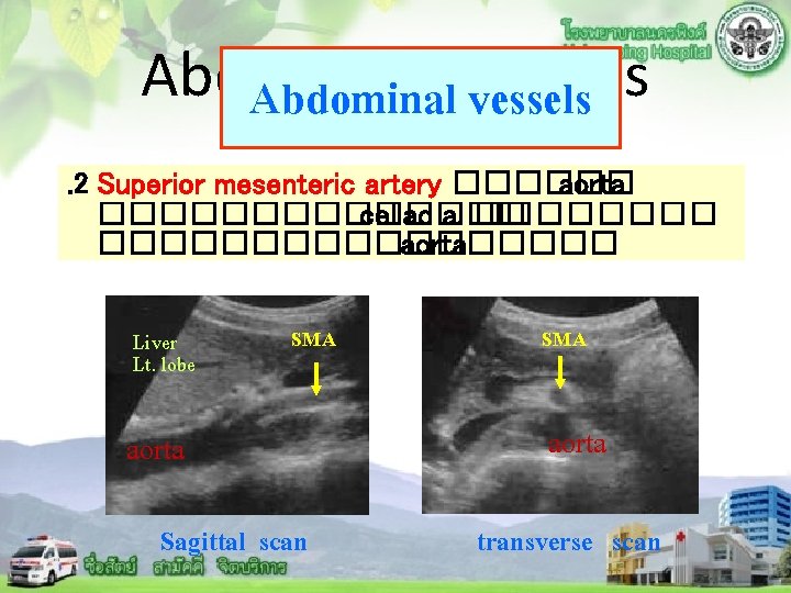 Abdominal vessels. 2 Superior mesenteric artery ������ aorta ������� celiac a. ������������� aorta Liver