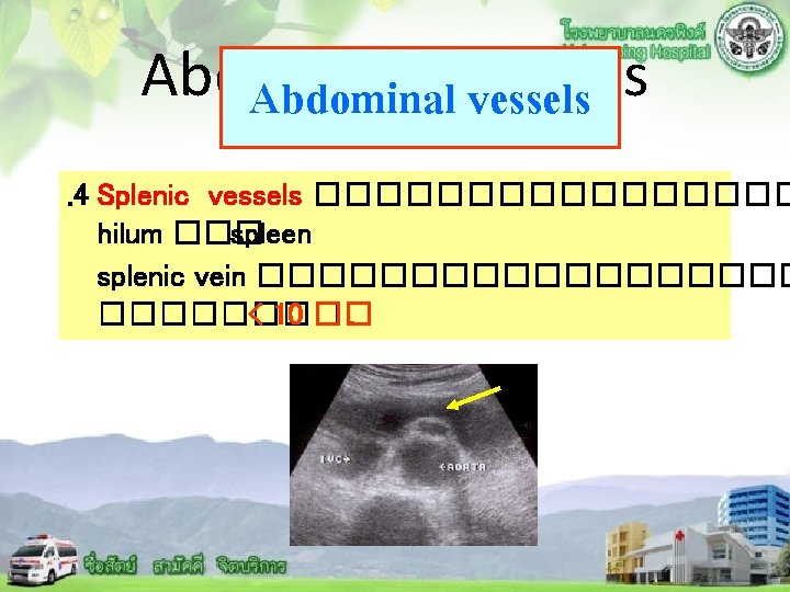 Abdominal vessels . 4 Splenic vessels �������� hilum ��� spleen splenic vein ��������� <