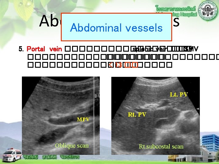 Abdominal vessels 5. Portal vein ��������� splenic vein ��� SMV �������������������� < 13 ��.