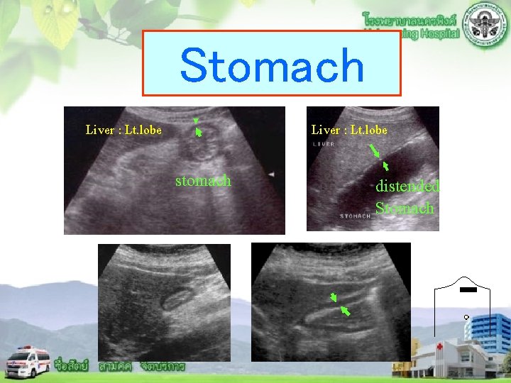 Stomach Liver : Lt. lobe stomach distended Stomach 