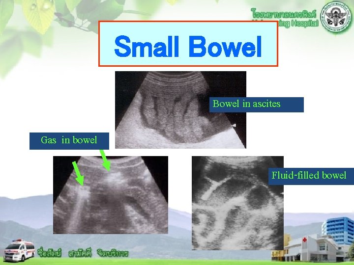 Small Bowel in ascites Gas in bowel Fluid-filled bowel 