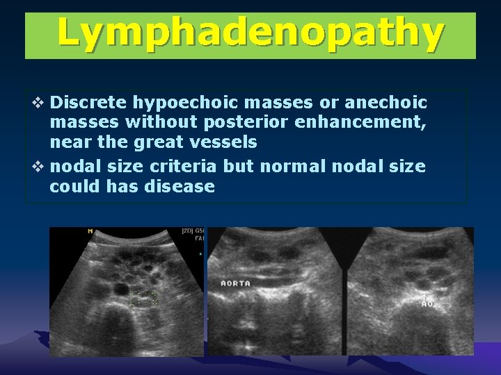 Lymphadenopathy v Discrete hypoechoic masses or anechoic masses without posterior enhancement, near the great