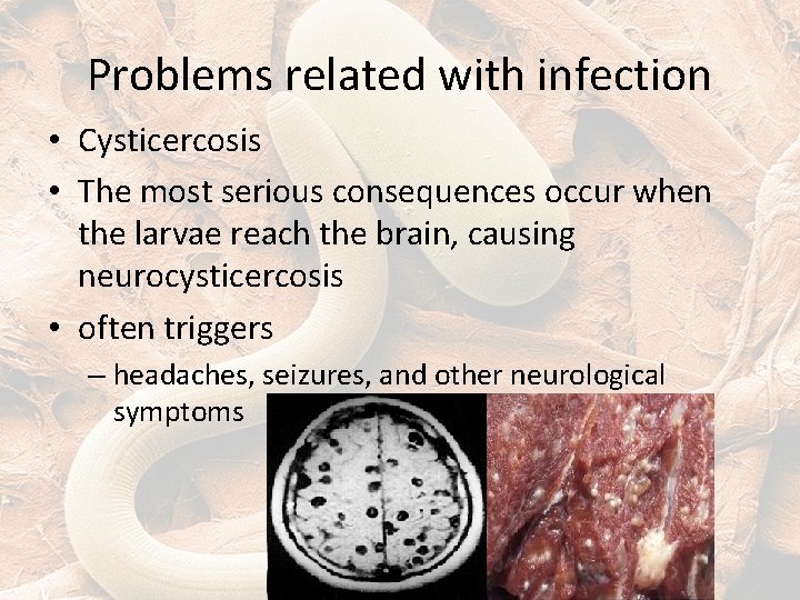 Problems related with infection • Cysticercosis • The most serious consequences occur when the