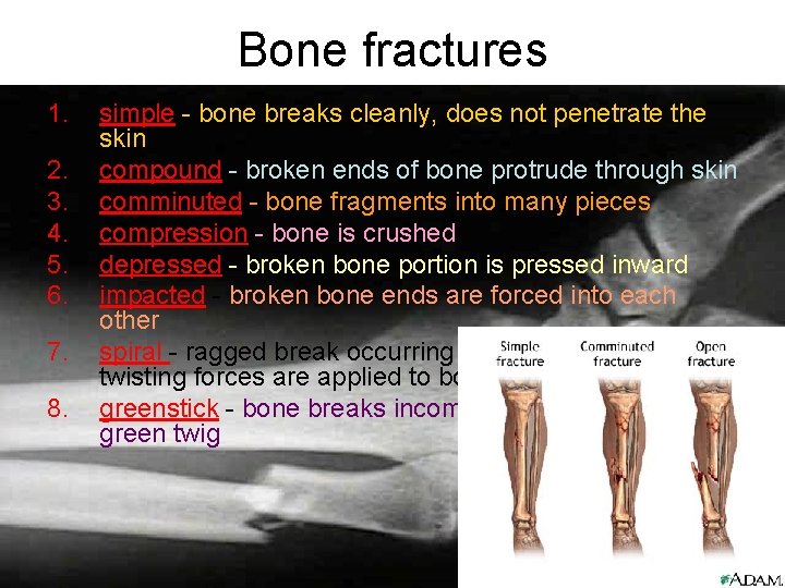 Bone fractures 1. 2. 3. 4. 5. 6. 7. 8. simple - bone breaks