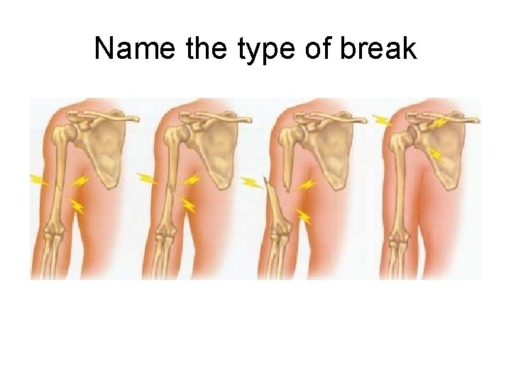 Name the type of break 