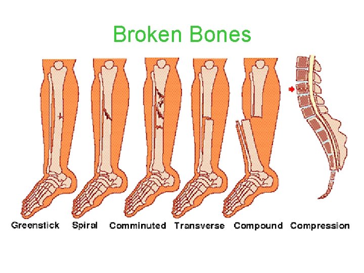 Broken Bones • There are three main types of joints based on structure: Fibrous