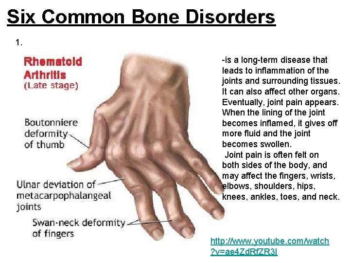 Six Common Bone Disorders 1. -is a long-term disease that leads to inflammation of