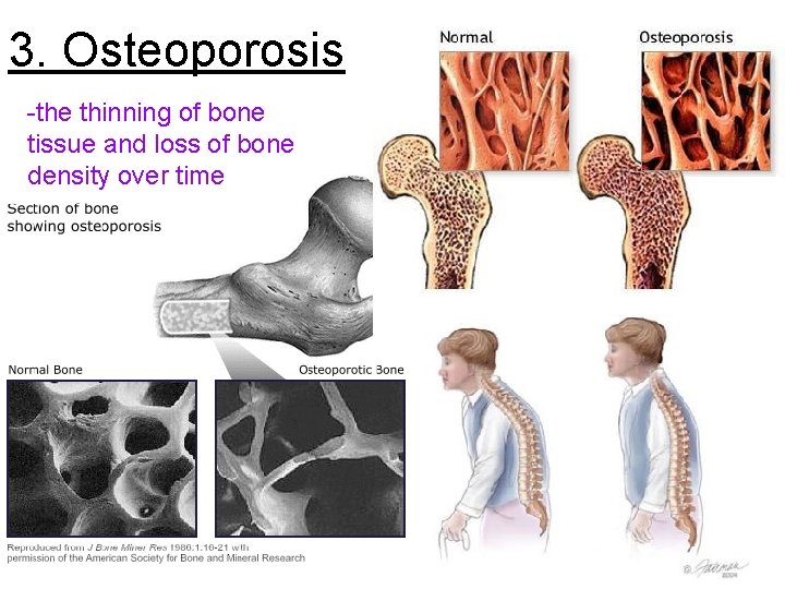 3. Osteoporosis -the thinning of bone tissue and loss of bone density over time