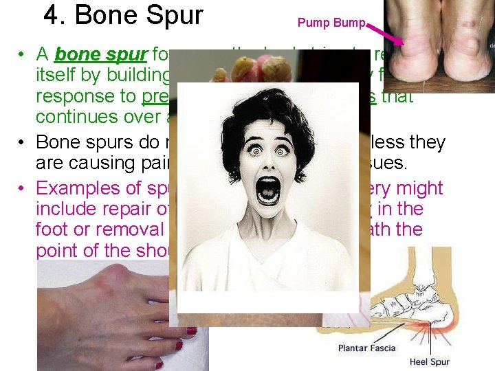 4. Bone Spur Pump Bump • A bone spur forms as the body tries