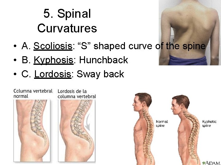 5. Spinal Curvatures • A. Scoliosis: “S” shaped curve of the spine • B.