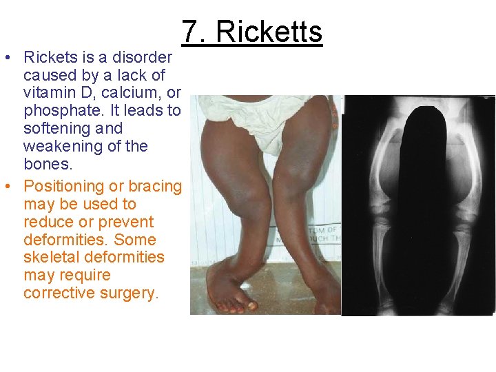 7. Ricketts • Rickets is a disorder caused by a lack of vitamin D,