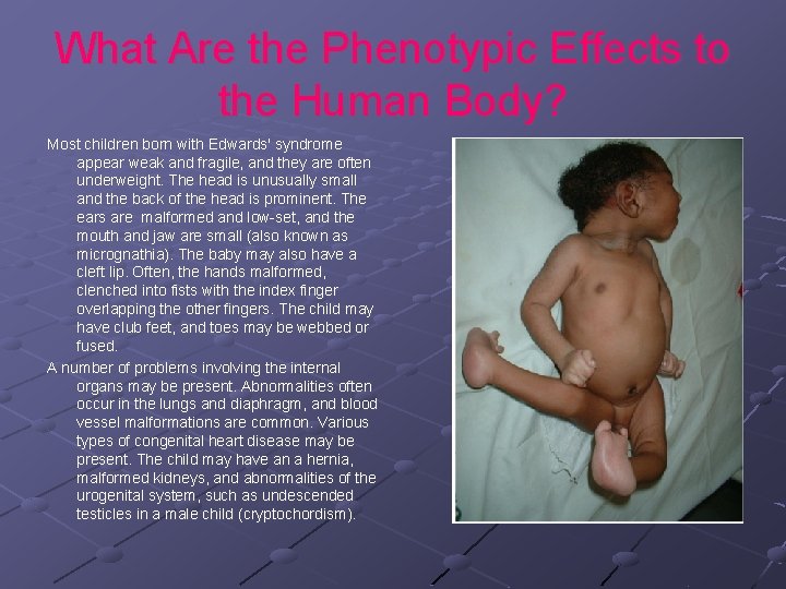 What Are the Phenotypic Effects to the Human Body? Most children born with Edwards'