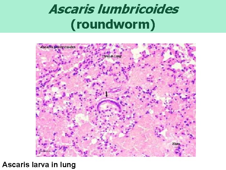 Ascaris lumbricoides (roundworm) Ascaris larva in lung 