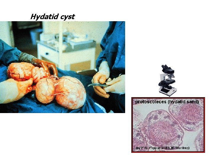 Hydatid cyst 