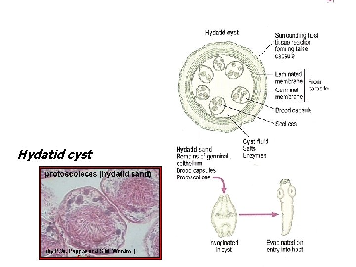 Hydatid cyst 
