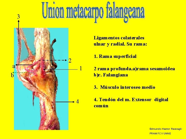 3 Ligamentos colaterales ulnar y radial. Su rama: a b 1. Rama superficial 2