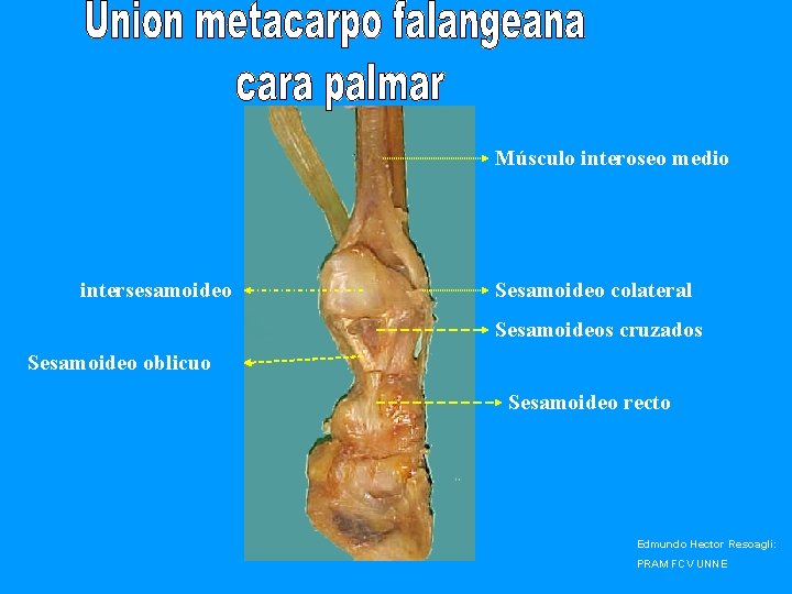Músculo interoseo medio intersesamoideo Sesamoideo colateral Sesamoideos cruzados Sesamoideo oblicuo Sesamoideo recto Edmundo Hector
