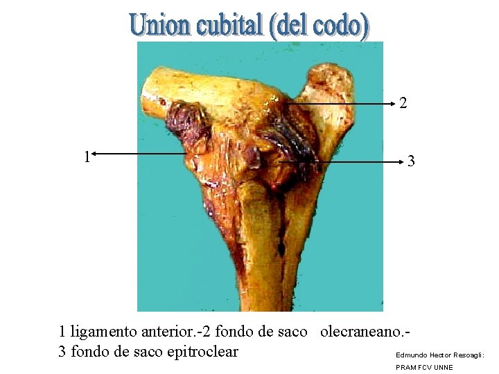 2 1 3 1 ligamento anterior. -2 fondo de saco olecraneano. 3 fondo de