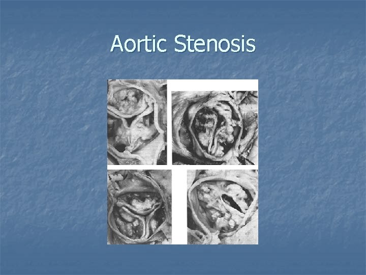 Aortic Stenosis 