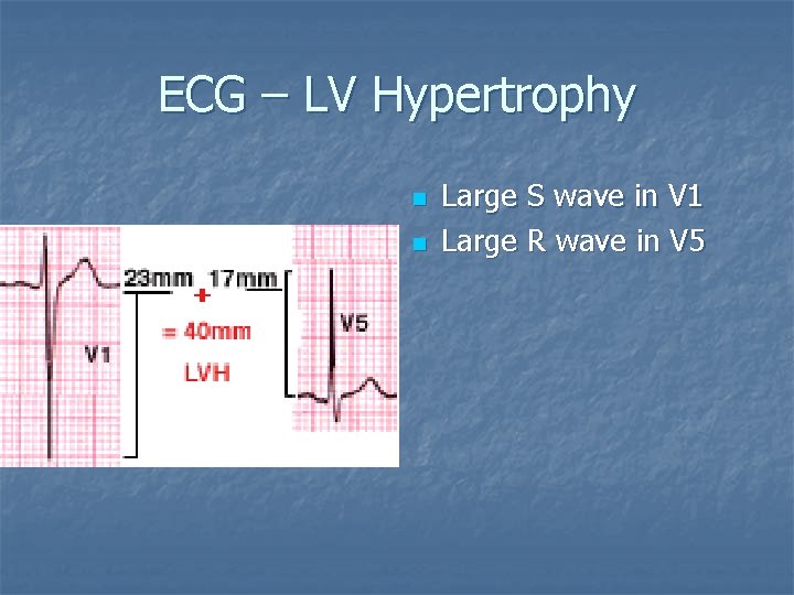 ECG – LV Hypertrophy n n Large S wave in V 1 Large R