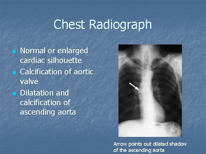 Chest Radiograph n n n Normal or enlarged cardiac silhouette Calcification of aortic valve