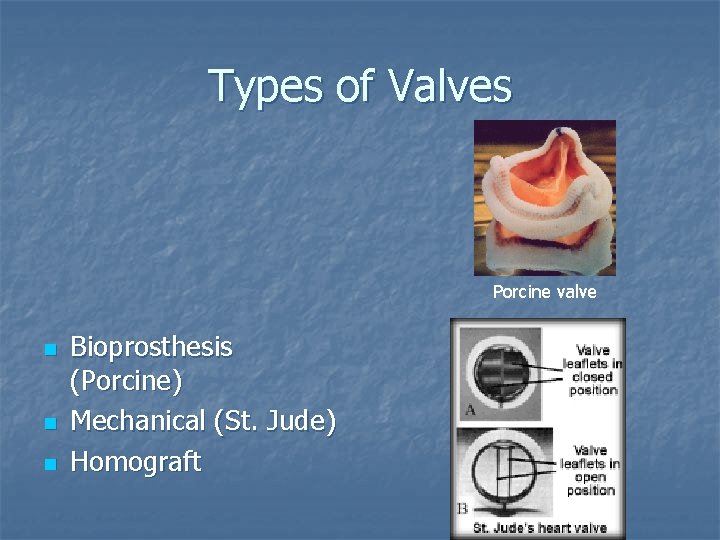Types of Valves Porcine valve n n n Bioprosthesis (Porcine) Mechanical (St. Jude) Homograft