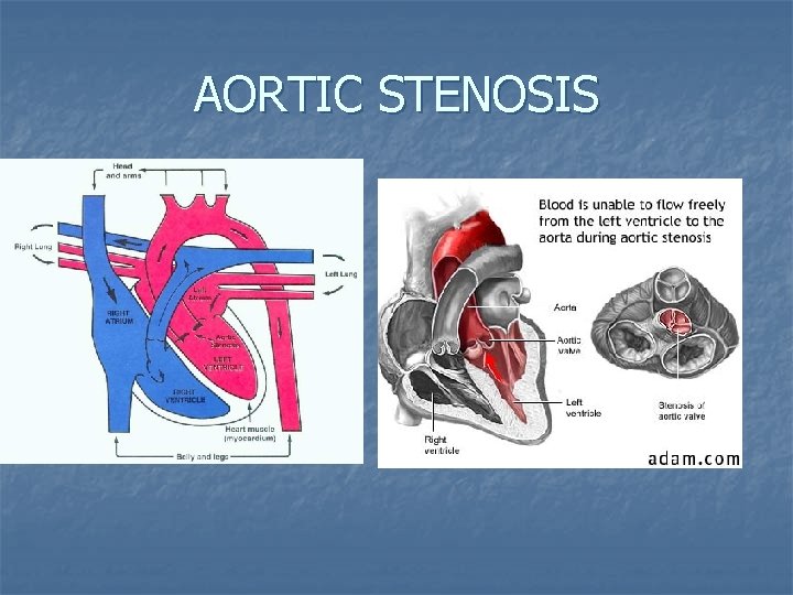 AORTIC STENOSIS 