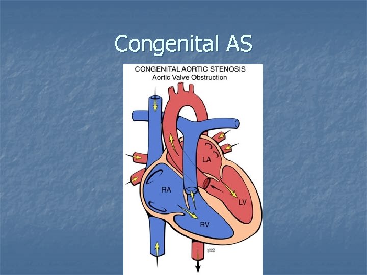 Congenital AS 