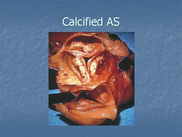 Calcified AS 